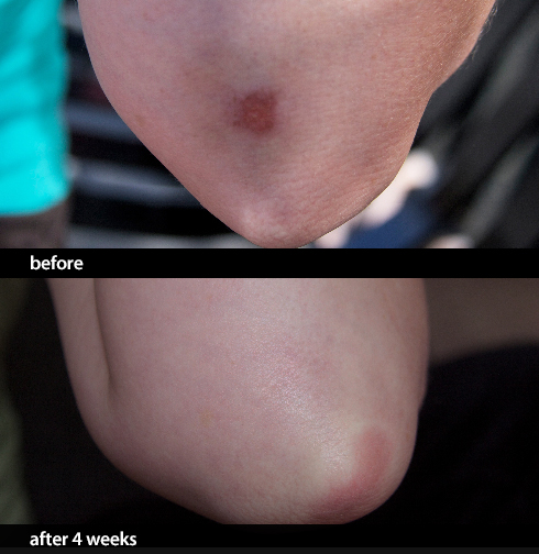 Dramatic CELSUS Scar Cream Before and After Results