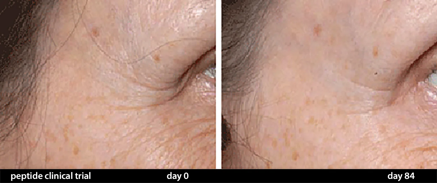 Anti Aging Results of CELSUS Scar Cream