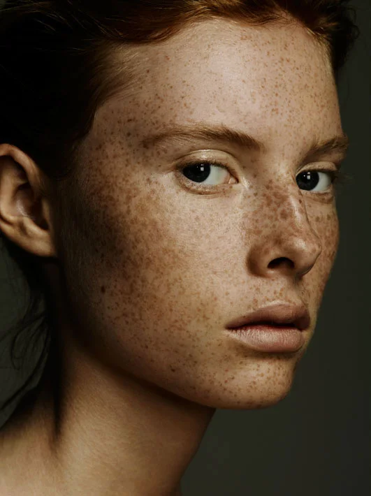 freckles-beauty.jpg