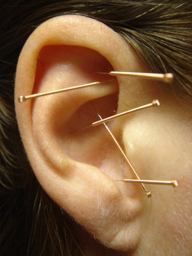 A woman’s ear with three acupuncture needles in it. Auricular acupuncture is very effective at stimulating the vagus nerve.