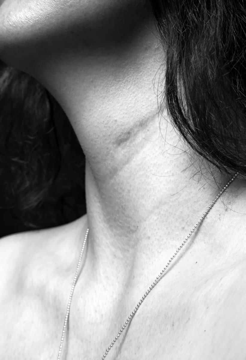 Mark (stitches, skin)