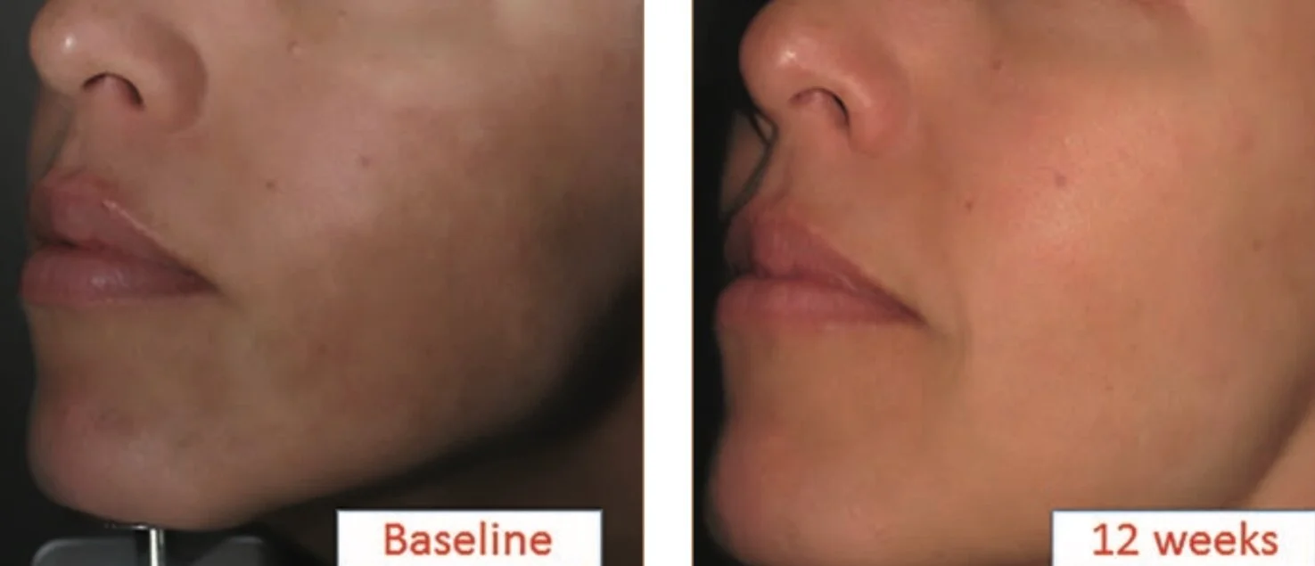 Green Led Light Therapy Melasma Shelly Lighting