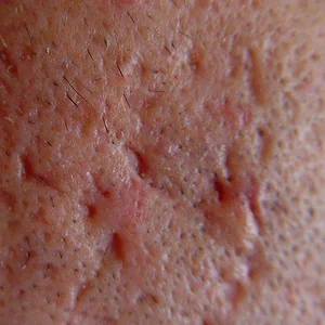 160313 痘坑冰锥 300x300.jpg