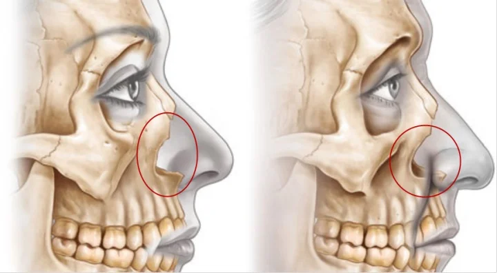 图左是年轻女性的面部骨骼示意图，图右则是随着时间流逝，面部骨骼会发生的变化，