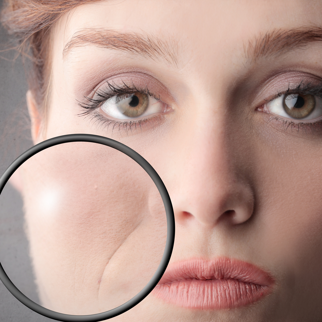 法令纹是你最大的困扰么？