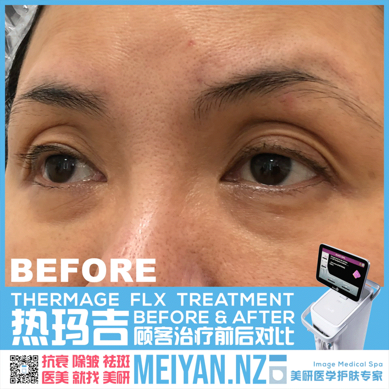 美研医学护肤专家 奥克兰 新西兰 医美 热玛吉 治疗 对比 抗衰 除皱 祛斑 找美研 美容院 对比图2.GIF