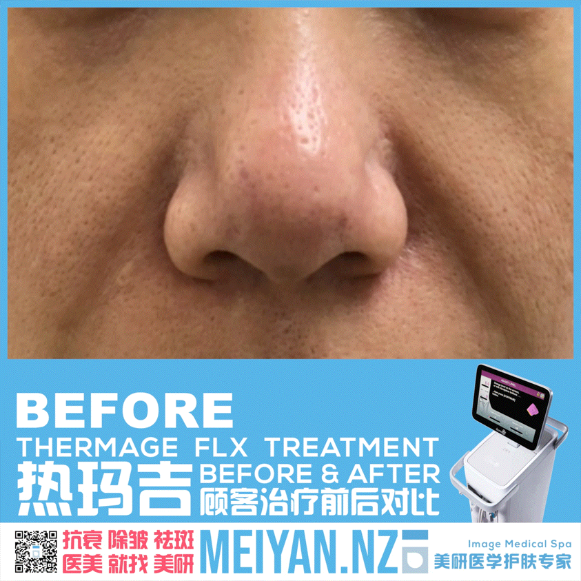 美研医学护肤专家 奥克兰 新西兰 医美 热玛吉 治疗 对比 抗衰 除皱 祛斑 找美研 美容院 对比图3.GIF