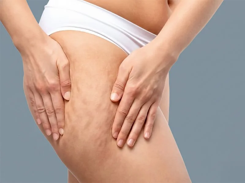 美研 医学护肤专家 医美 奥克兰 新西兰 PrimeX 普娜提 橘皮