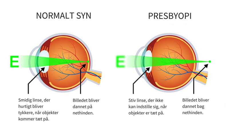 presbyopida.png