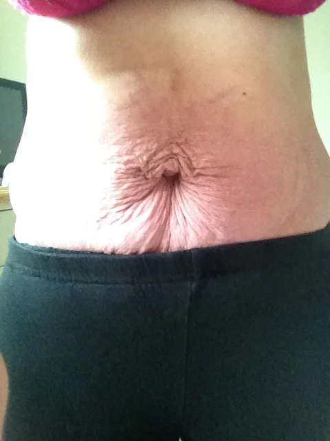 Post-babies! Excess skin tucked into my leggings. My belly button resembled a Cat's Bum! 