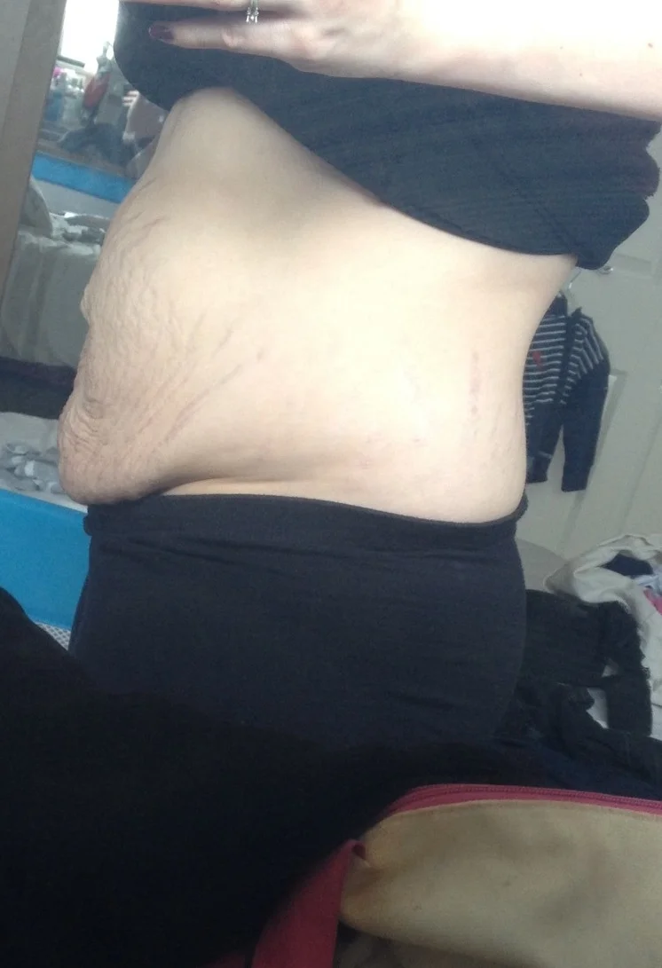 One month after giving birth. The hernia makes it look like I still have a baby in there!