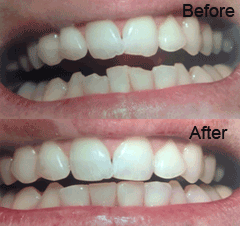  Bonded Restorations