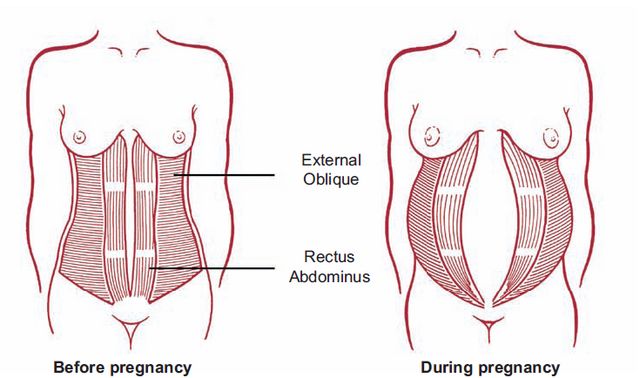 diastasis during pregnancy.jpeg