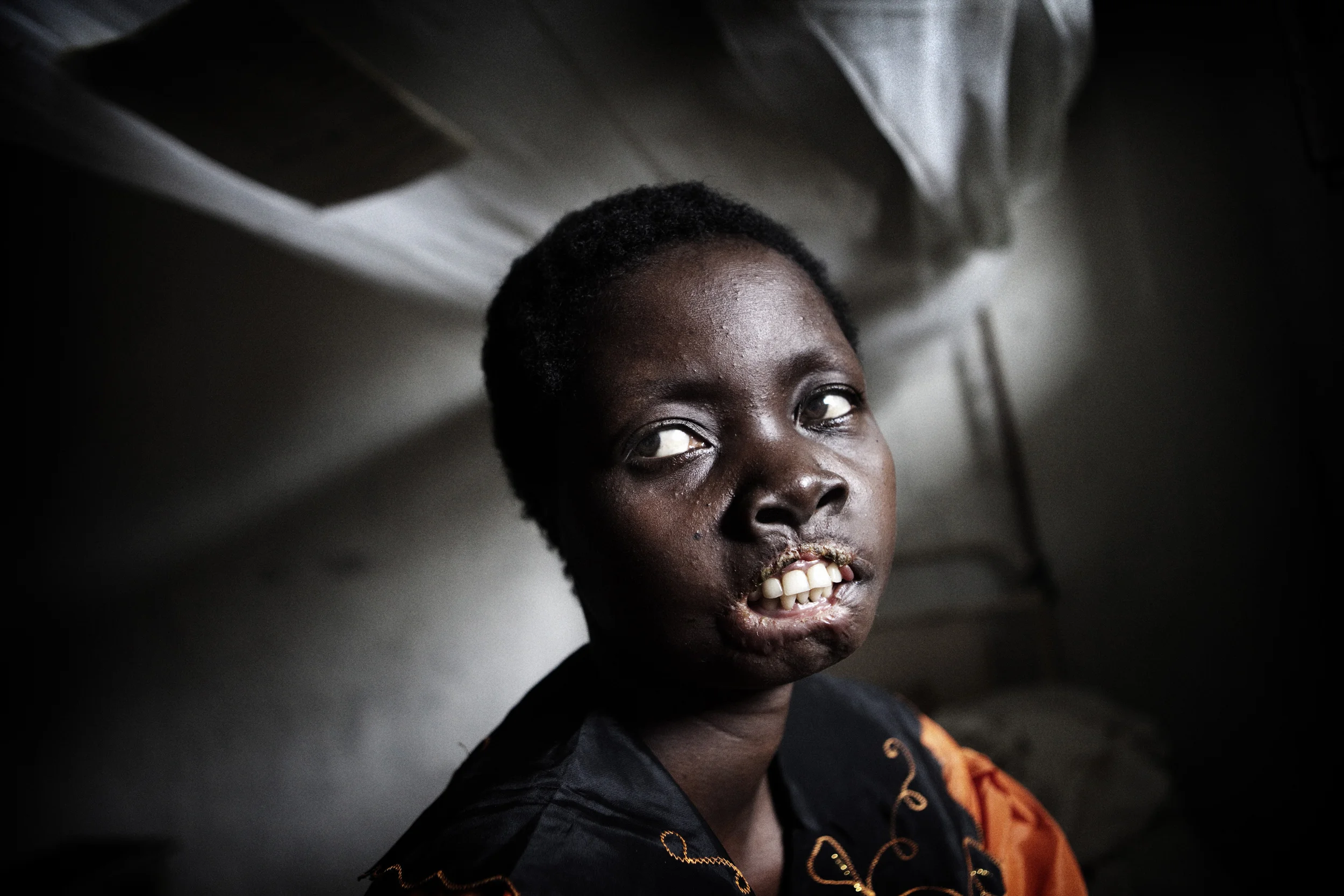 Mbonih Ndele Mari was abducted by the LRA outside Niangara she was left for dead by them after they cut off her lips and her ears. She in now in hospital in Niangara her children are being looked after by family close by. 