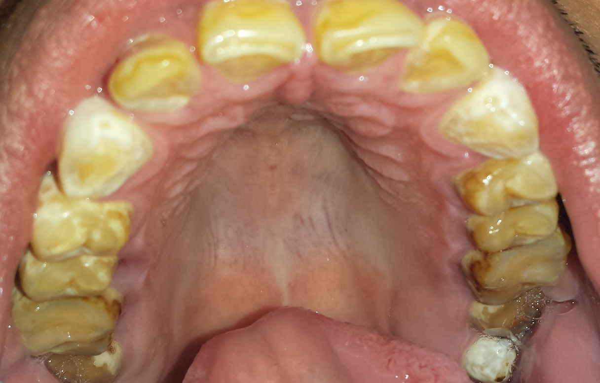 Before Treatment