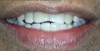After Treatment