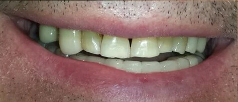 After Treatment