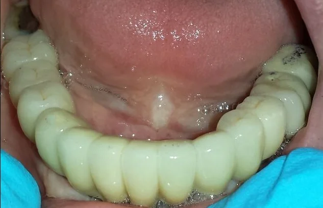 After Treatment