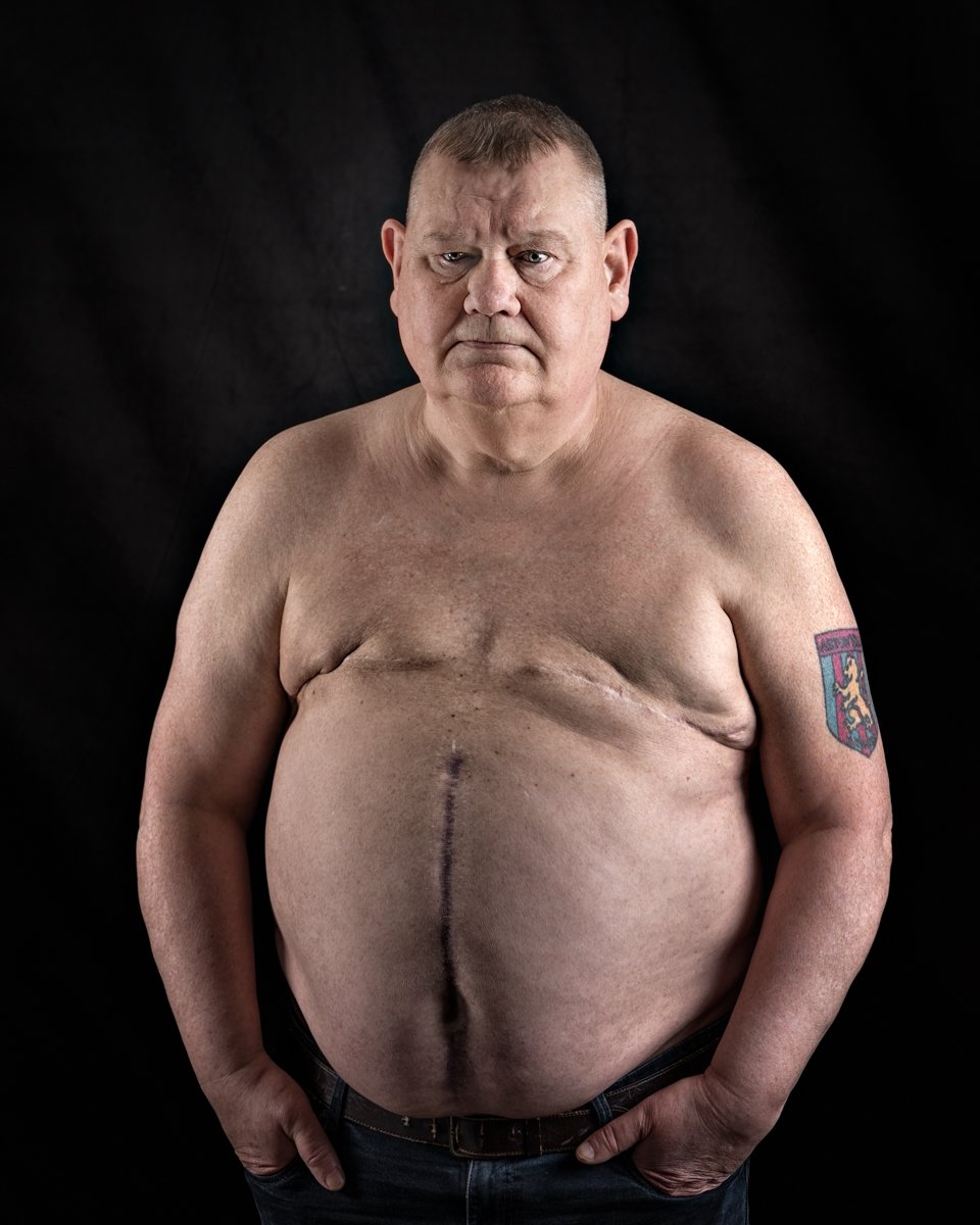 Man with secondary breast cancer