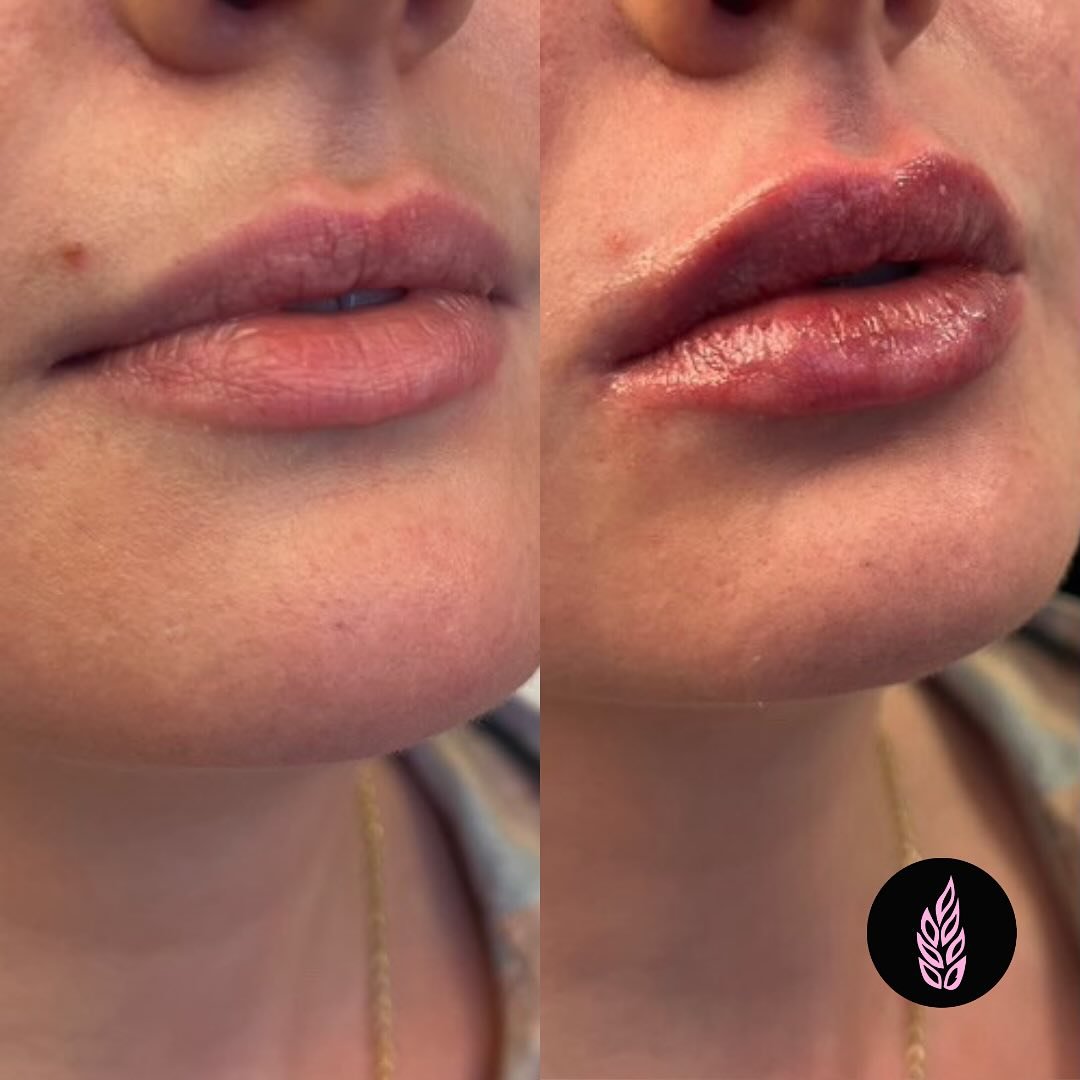 Just a subtle boost with half a syringe of lip filler for this lovely client, all thanks to our talented injector Courtney! We love seeing the results and the confidence it brings! 💋