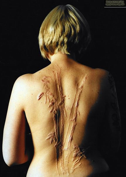 Brian Decker back scar.jpg