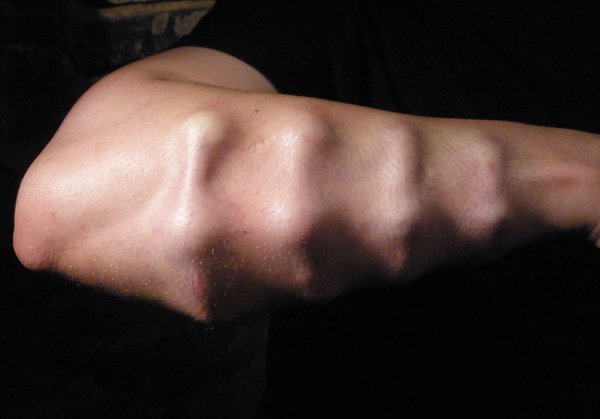 Brian Decker forearm implants.jpg