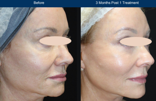 Female Before and After Ultraclear Laser Skin Resurfacing