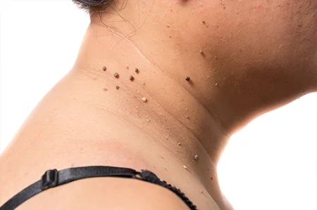 skintag.jpg