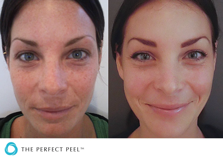face peel clinic