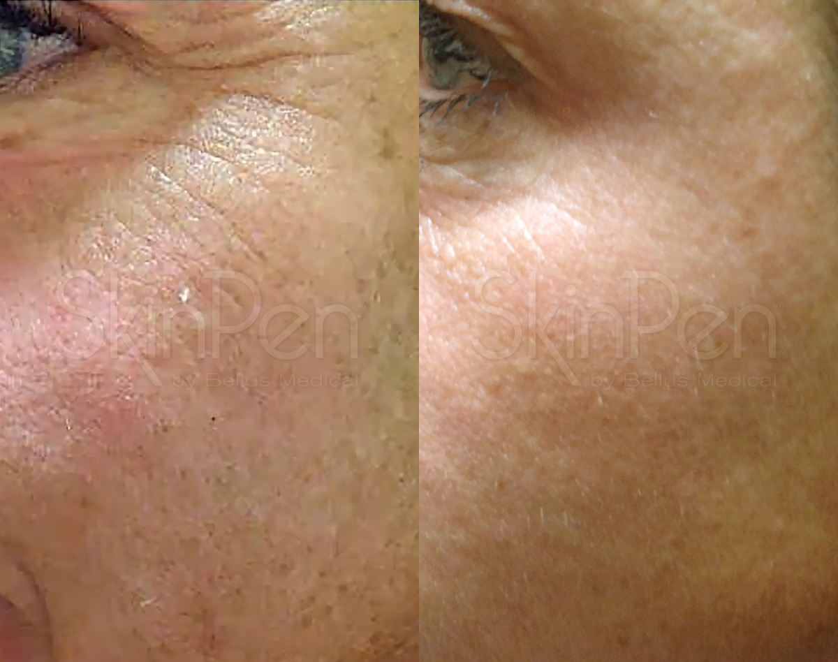 B & A SkinPen -wm (1).jpg