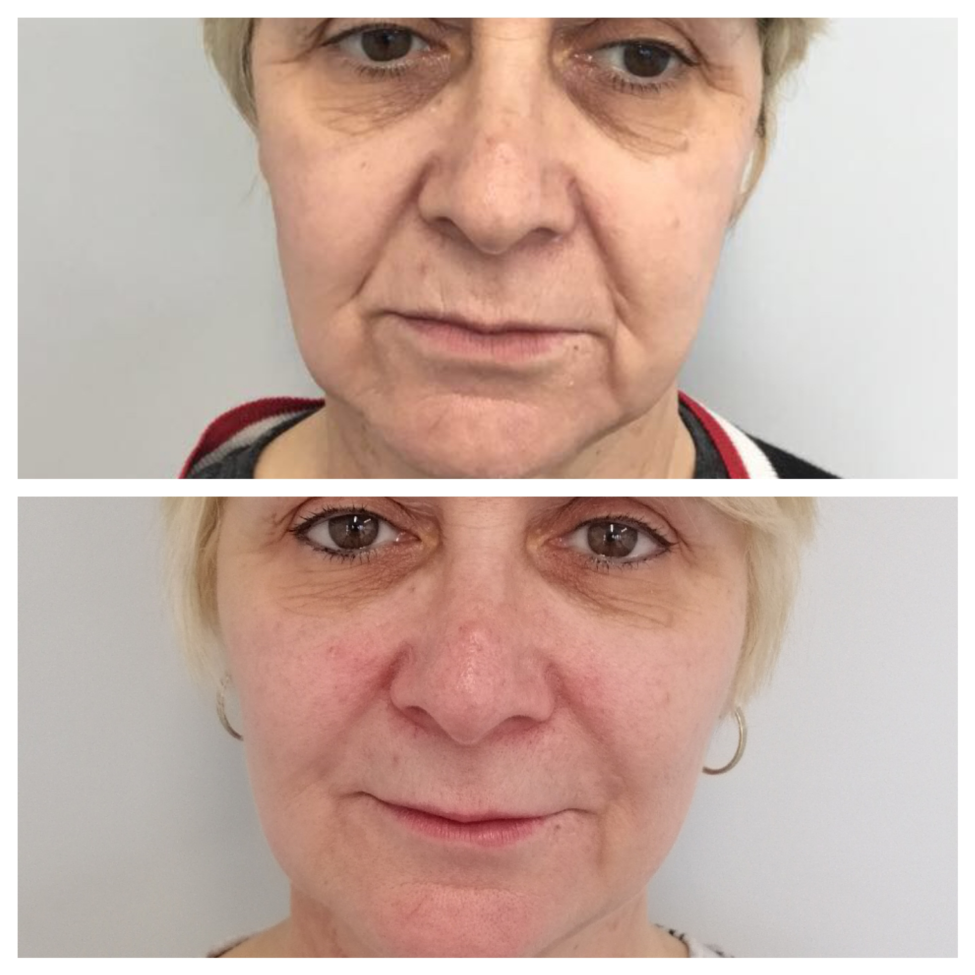 Dermal Filler Treatment in Oxford