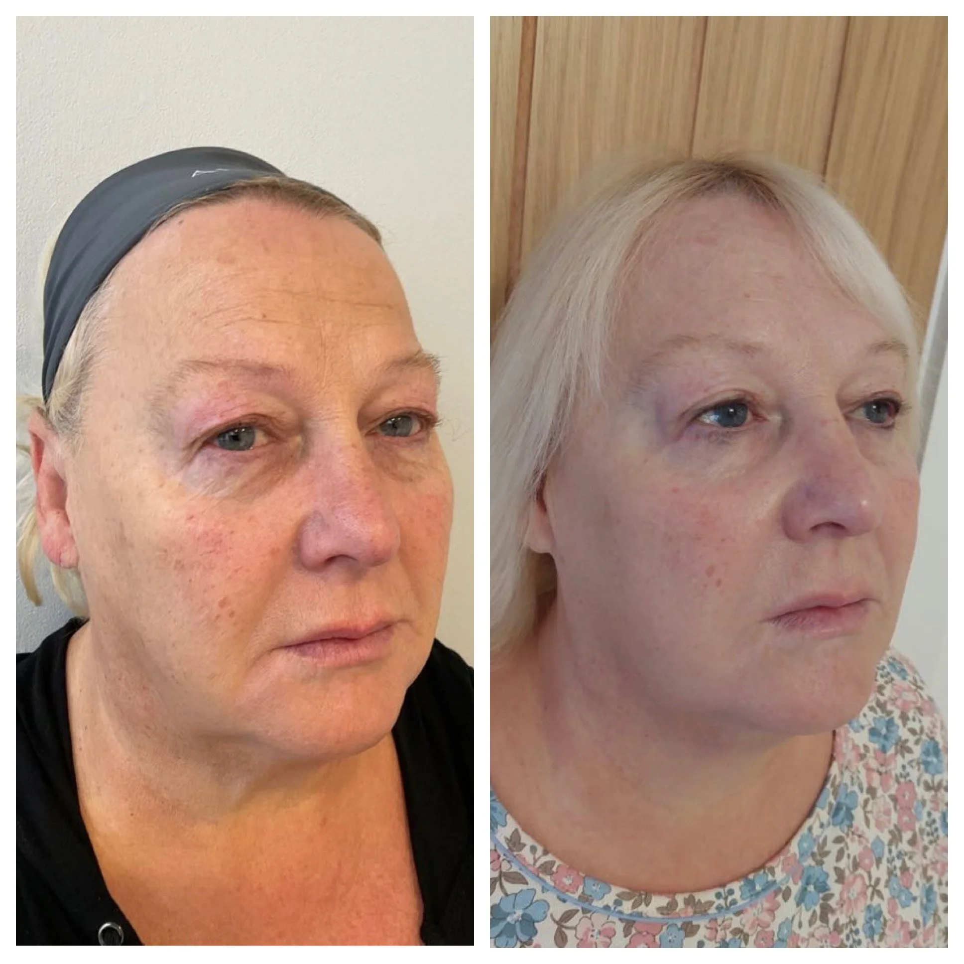 HIFU NonSurgical Medical Skin Tightening Treatment In Oxfordshire — Lumiere Medispa Skin