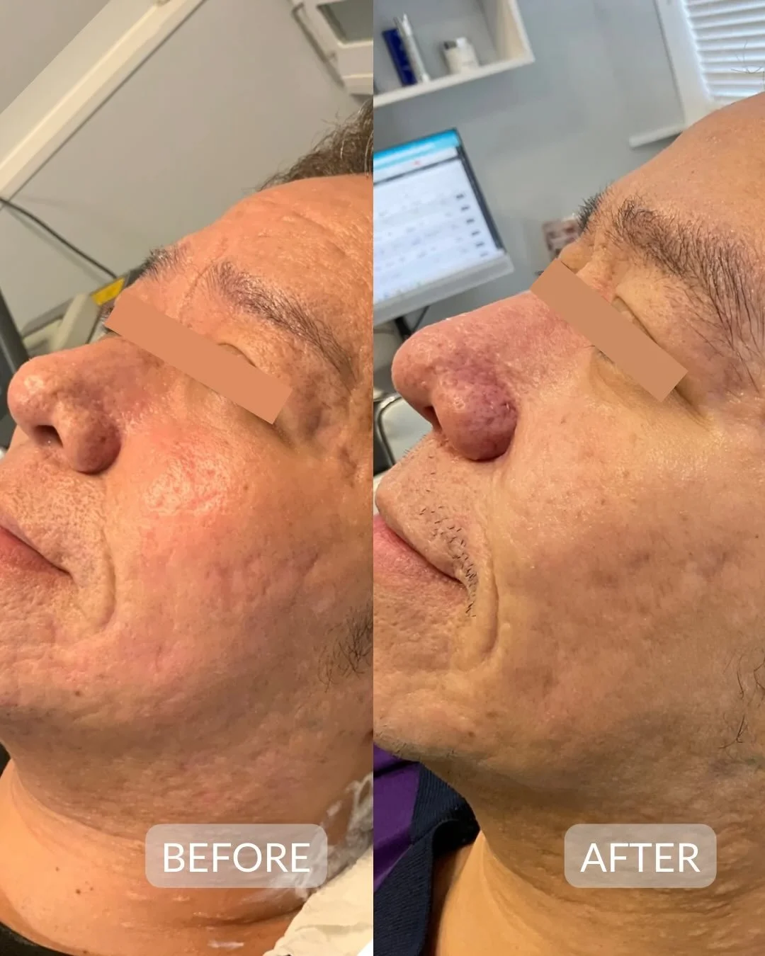 Polynucleotides &amp; Microneedling

We are absolutely loving this patients results! Our patient has completed a course of microneedling alongside three sessions of polynucleotides and the improvement in skin quality and scarring speaks for itself.

