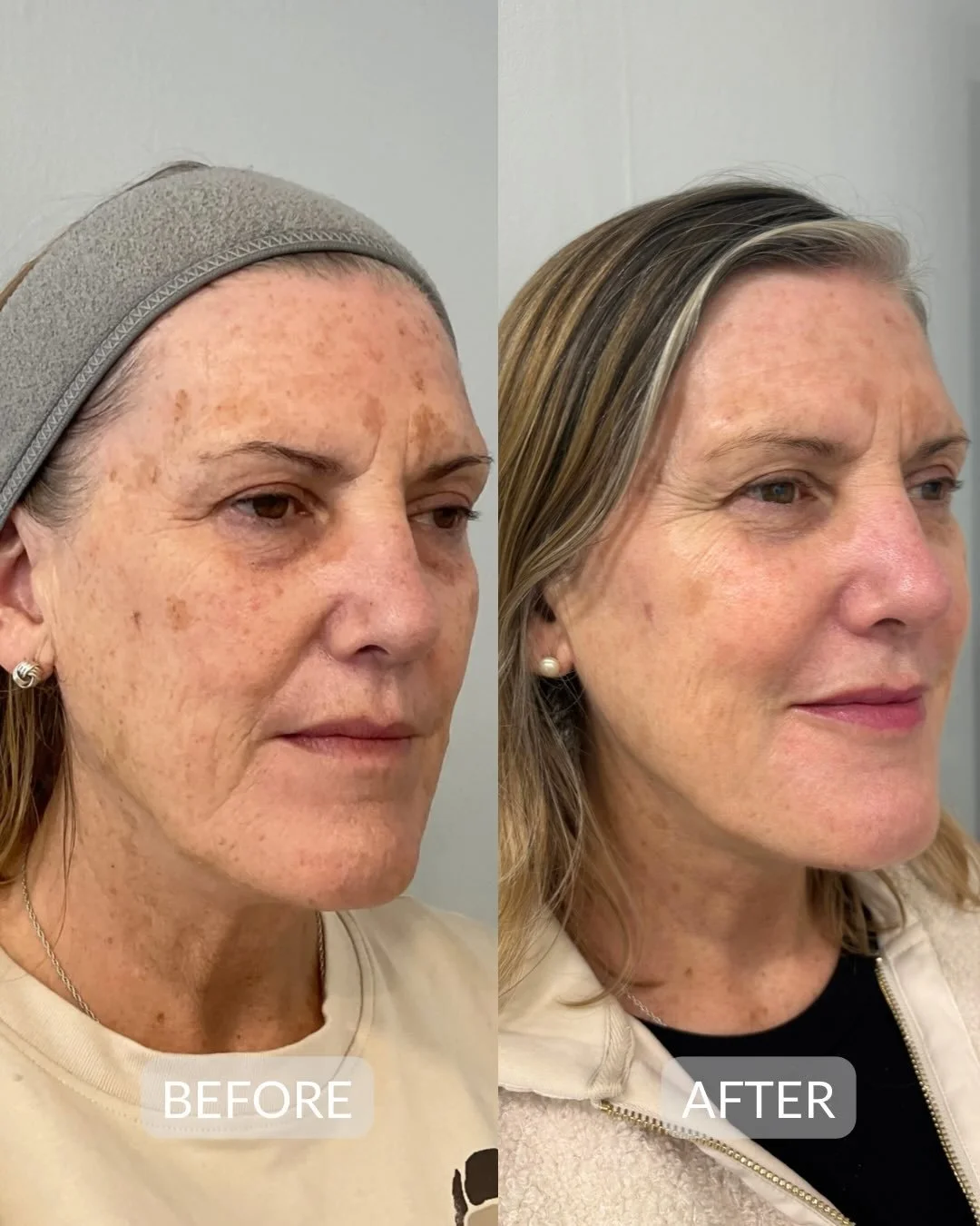 Dermal fillers &amp; IPL

Incredible transformation! This result shows what a combination of dermal fillers and IPL can achieve together.

Dermal fillers were used to restore volume in the lower face, creating lift and rebuilding structure that natur