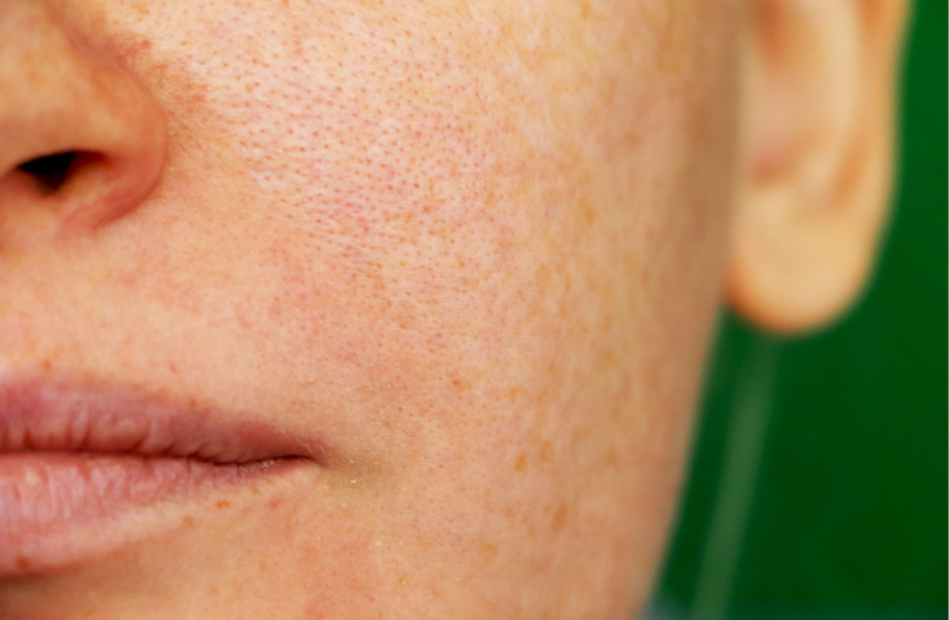 How to Treat Pigmentation in Winter: Why Now Is the Best Time