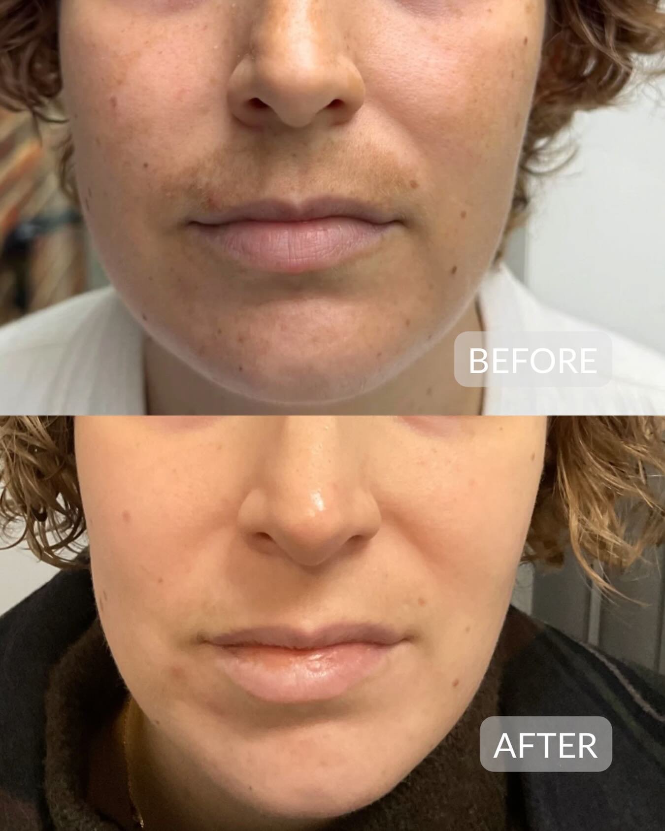 Pigmentation doesn't appear overnight and it shouldn't be treated with a one-size-fits-all approach!

This before &amp; after shows the results of our in-house developed compound treatment protocol, created using scientific research and clinical expe