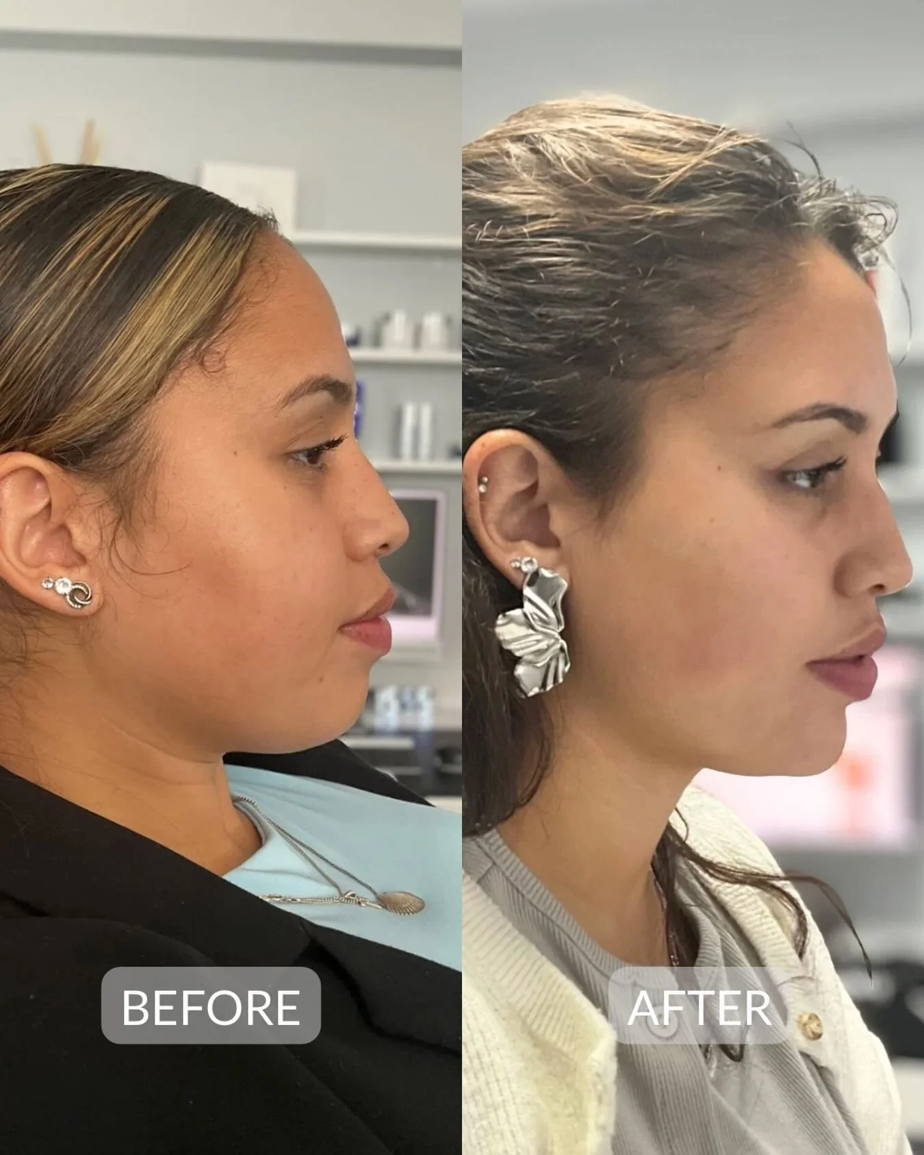 Small adjustments.. Great results!

Chin enhancement achieved with dermal filler to create profile harmony. A subtle tweak that enhanced the chin and balanced the profile, restoring confidence whilst keeping it natural. If you're curious to find out 