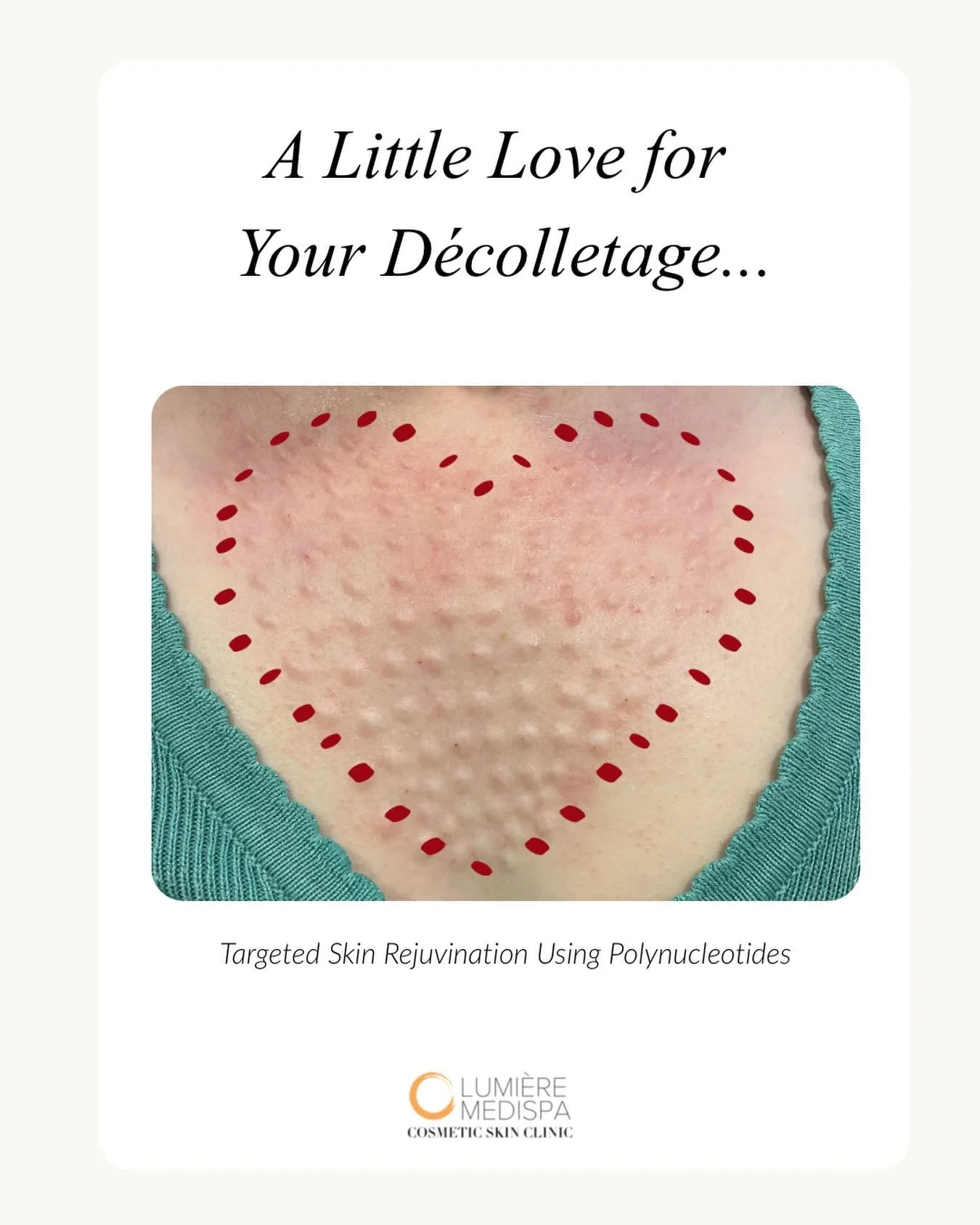 Polynucleotides for D&eacute;colletage Rejuvenation

The delicate skin of the chest is one of the first areas to show signs of ageing such as creepiness, fine lines and loss of elasticity.

Polynucleotide treatments work at cellular level to deeply r