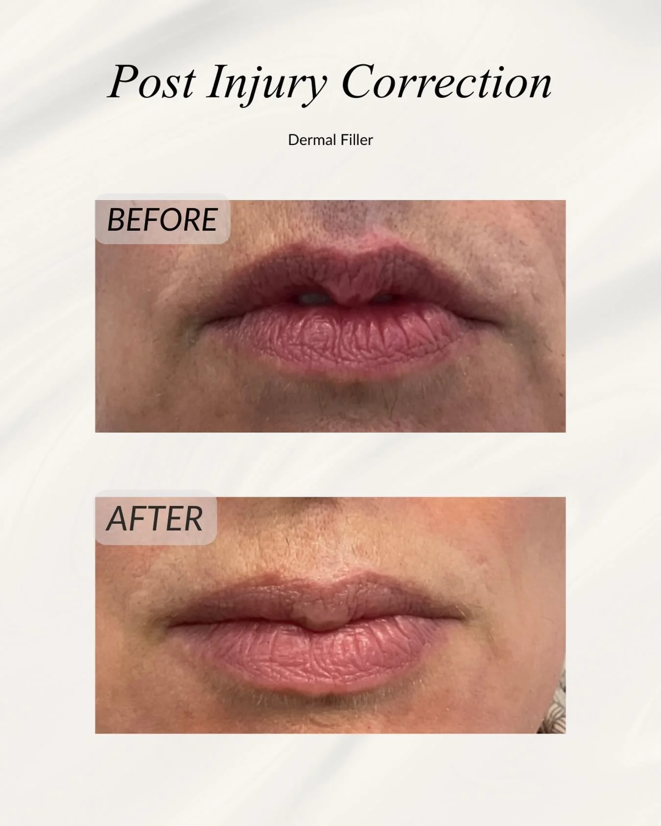 Corrective dermal filler can play a powerful role in restoring balance and confidence after trauma.

This patient came to us following a bike accident that left her lips damaged and uneven. Using a careful, corrective approach, we were able to rebuil