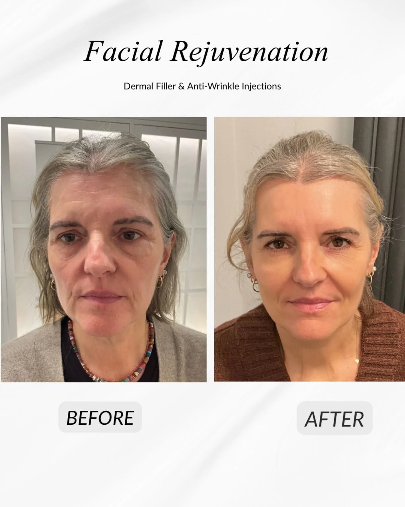 Amazing transformation achieved.
This patient attended the clinic hoping to restore volume and facial structure, while maintaining a natural and refreshed appearance.

Expert Aesthetic Nurse Janki Rai achieved this result using carefully placed hyalu