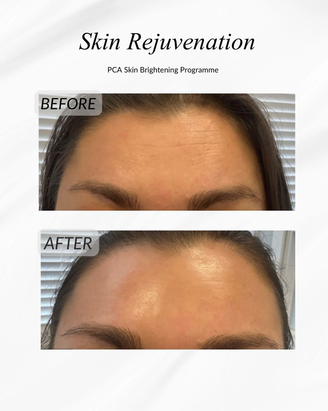 This is your sign that skincare really does work!

These amazing results were achieved using the PCA Skin Brightening Programme over just 3 months. No needles, no laser, just expertly chosen skincare and a treatment plan tailored to the individual.

