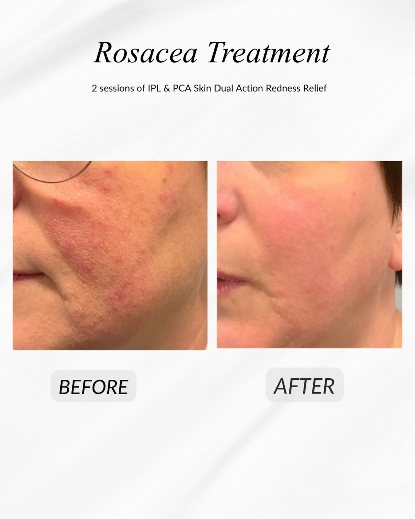 Struggling with redness or looking to better manage your rosacea? 

These results were achieved after just 2 IPL sessions , combined with the PCA Skin Dual Action Redness Relief to support the skin at home. 

Start your journey to a calmer, more bala