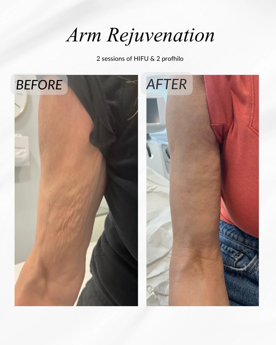 Looking to feel more confident in your body? Aesthetic treatments aren't just for the face.

This before and after shows the early results of a combined treatment approach using HIFU and Profhilo, designed to lift, tighten, and deeply hydrate the ski