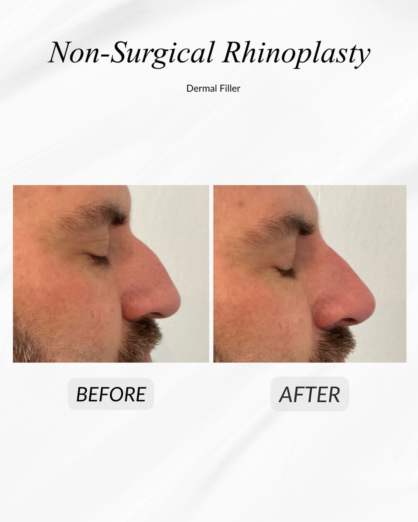 Would you like to feel more confident with the shape of your nose, without undergoing surgery ?

This before and after is a non-surgical rhinoplasty. Using expertly placed dermal filler, this treatment can help create a straighter profile, improved f