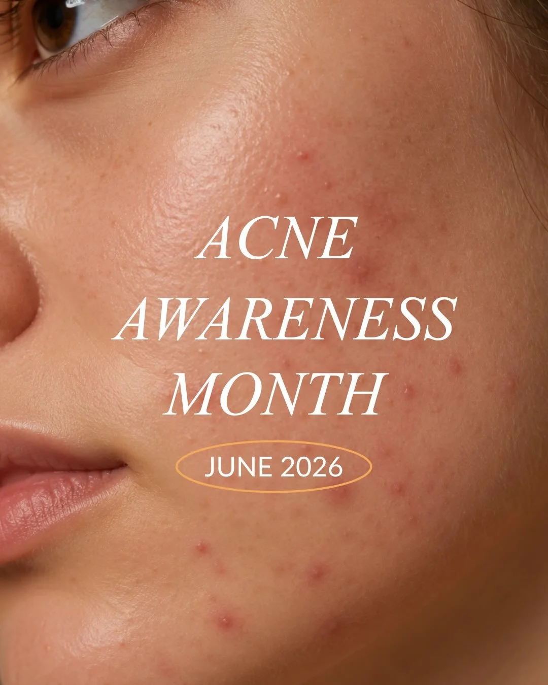 It's Acne Awareness Month! Throughout the month, we'll be sharing expert tips, advice, and information to help you understand acne, identify potential triggers, and explore the treatments available to help you achieve clearer skin. 

Keep an eye on o