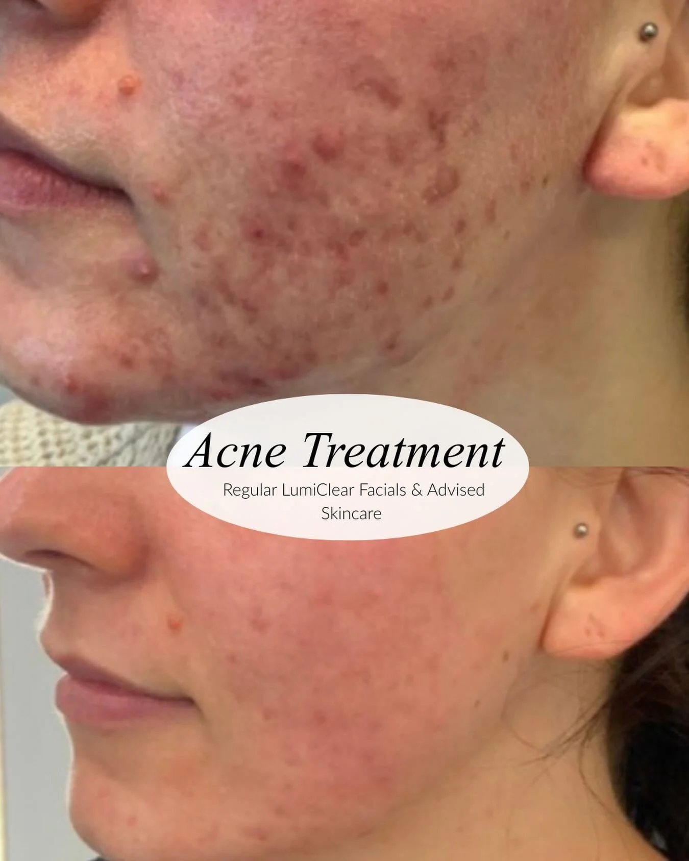 Before &amp; After

This transformation was achieved through regular LumiClear Acne Facials combined with a personalised home skincare routine.

By targeting congestion, inflammation and blocked pores month after month, we've helped this patient's sk
