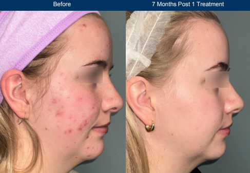 Yound female before and after photo showing acne before and after Ultraclear 3DMIRACL laser treatment