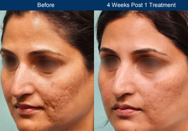 Before and after photo of a female who has received Ultraclear Laser demonstrating a substantial reduction in acne scarring