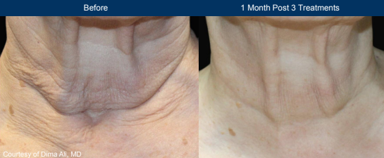 Before and after photo of a female neck with significant skin laxity before and firmer tighter neck skin after Ultraclear laser
