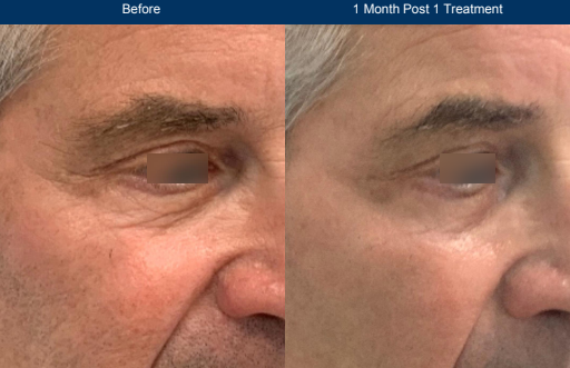 Before and after of a white male having received UltraClear Laser-Coring to his eye skin for skin tightening